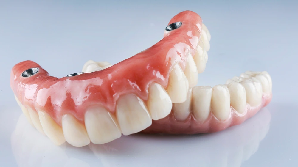 Close-up of a dental implant-supported denture showcasing artificial teeth and titanium posts used for tooth replacement.