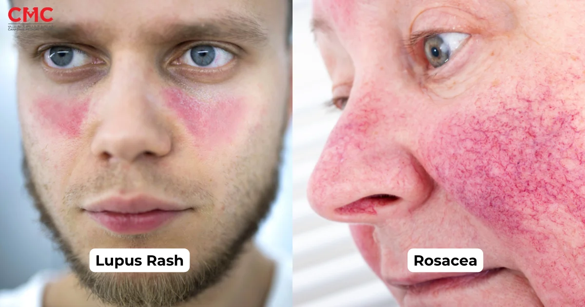 Lupus rash vs rosacea: Visual comparison of facial symptoms for better understanding.