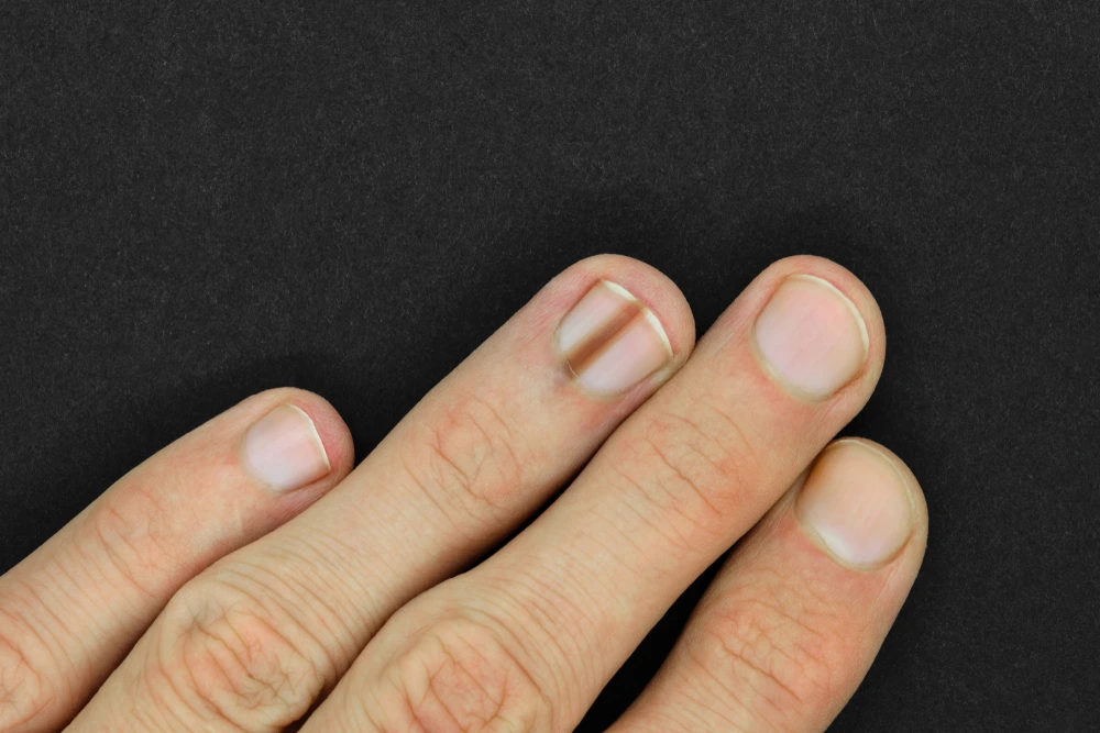 Close-up of fingers showing melanonychia on the middle fingernail, characterized by a dark brown vertical stripe.