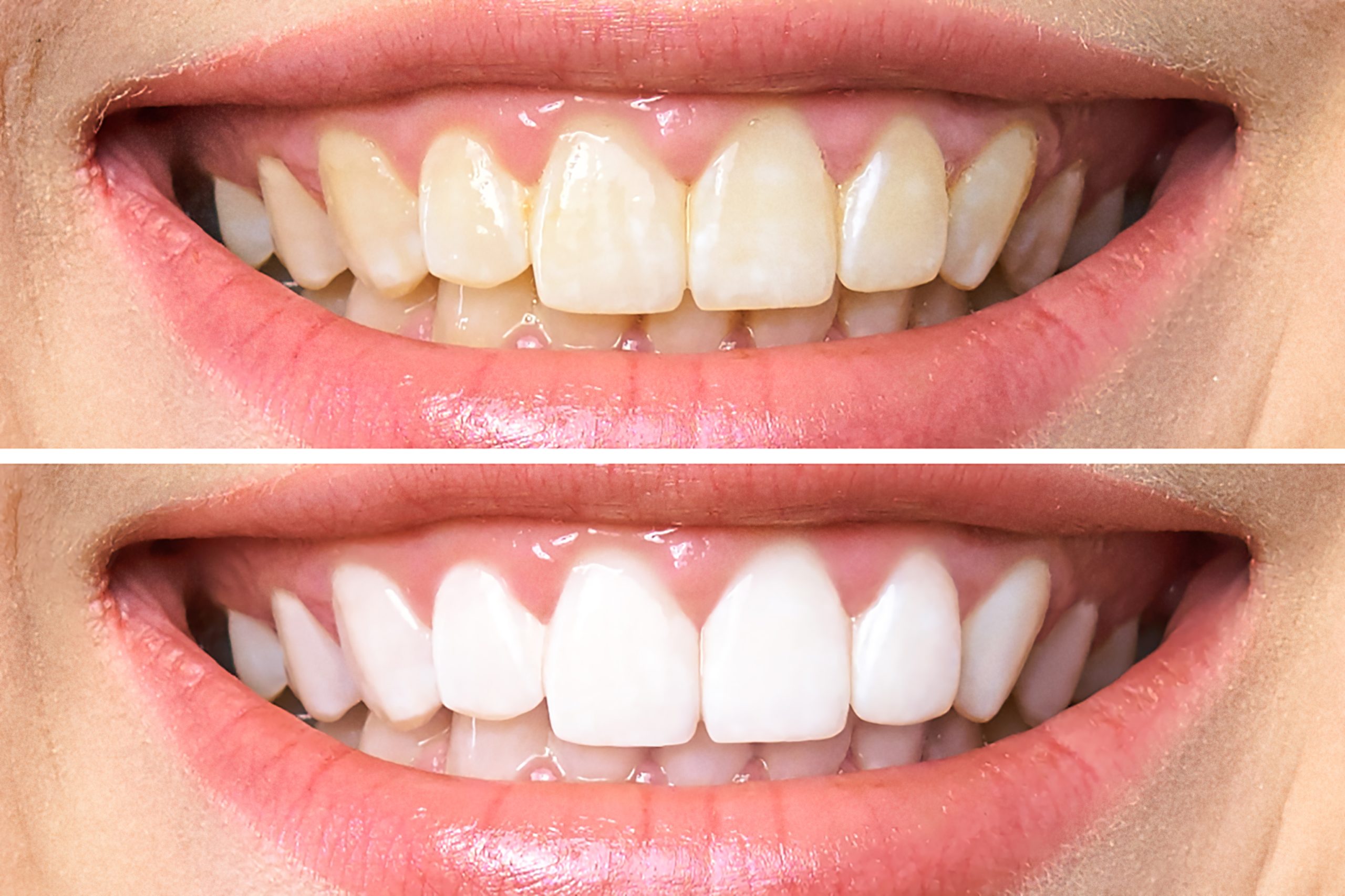 teeth whitening teeth whitening