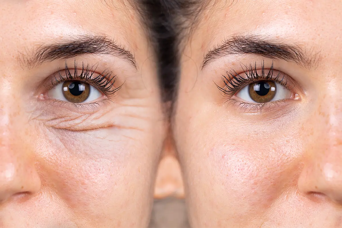 Under-Eye Wrinkle Reduction – Before and After Skin Treatment Results