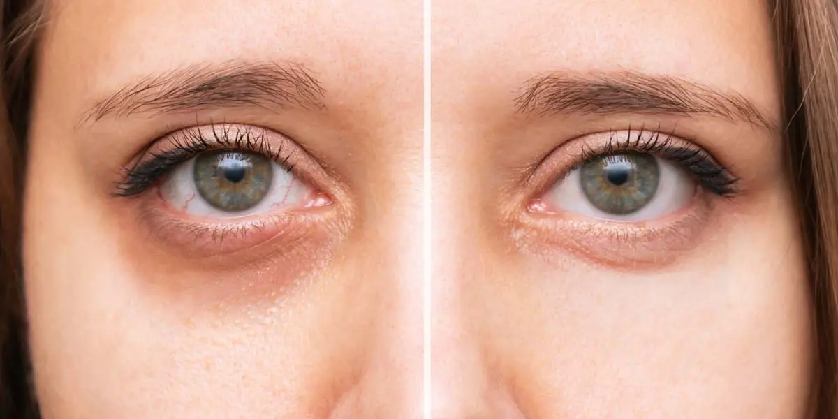 Close-up of a woman with dark circles under her eyes