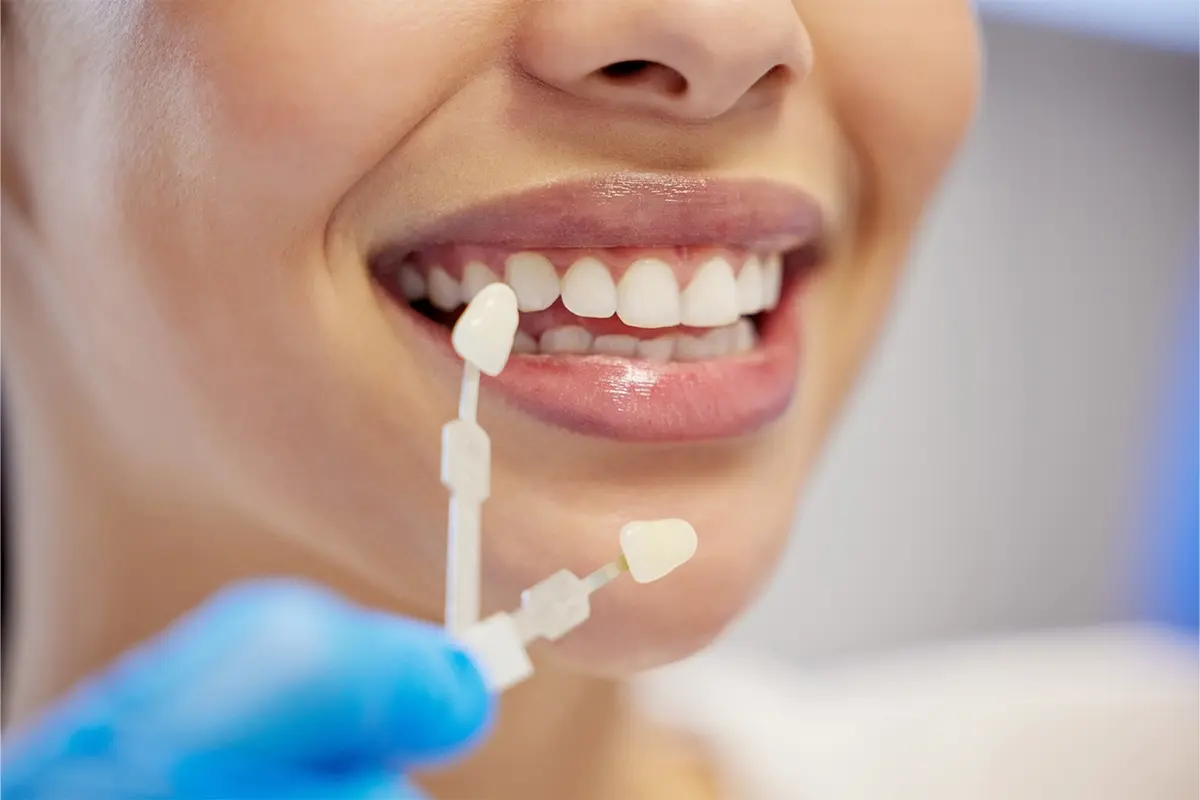 Close-up of a patient smiling while a dentist compares a veneer shade